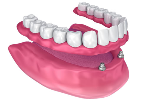 snap on denture