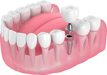 implant solution