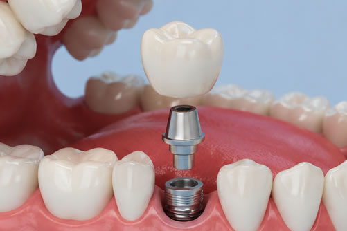 implants
